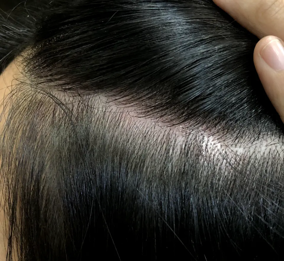 Scalp Specialist Treatment 4
