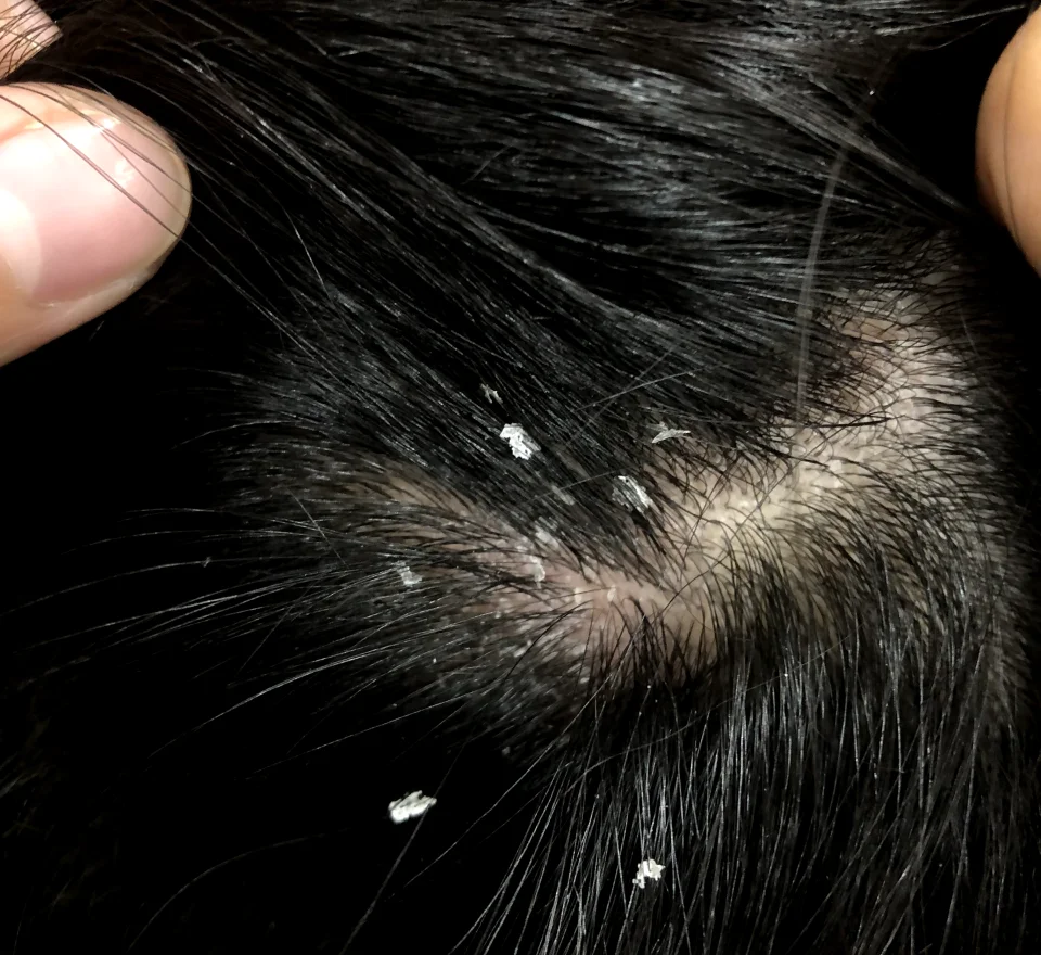 Scalp Specialist Treatment 3