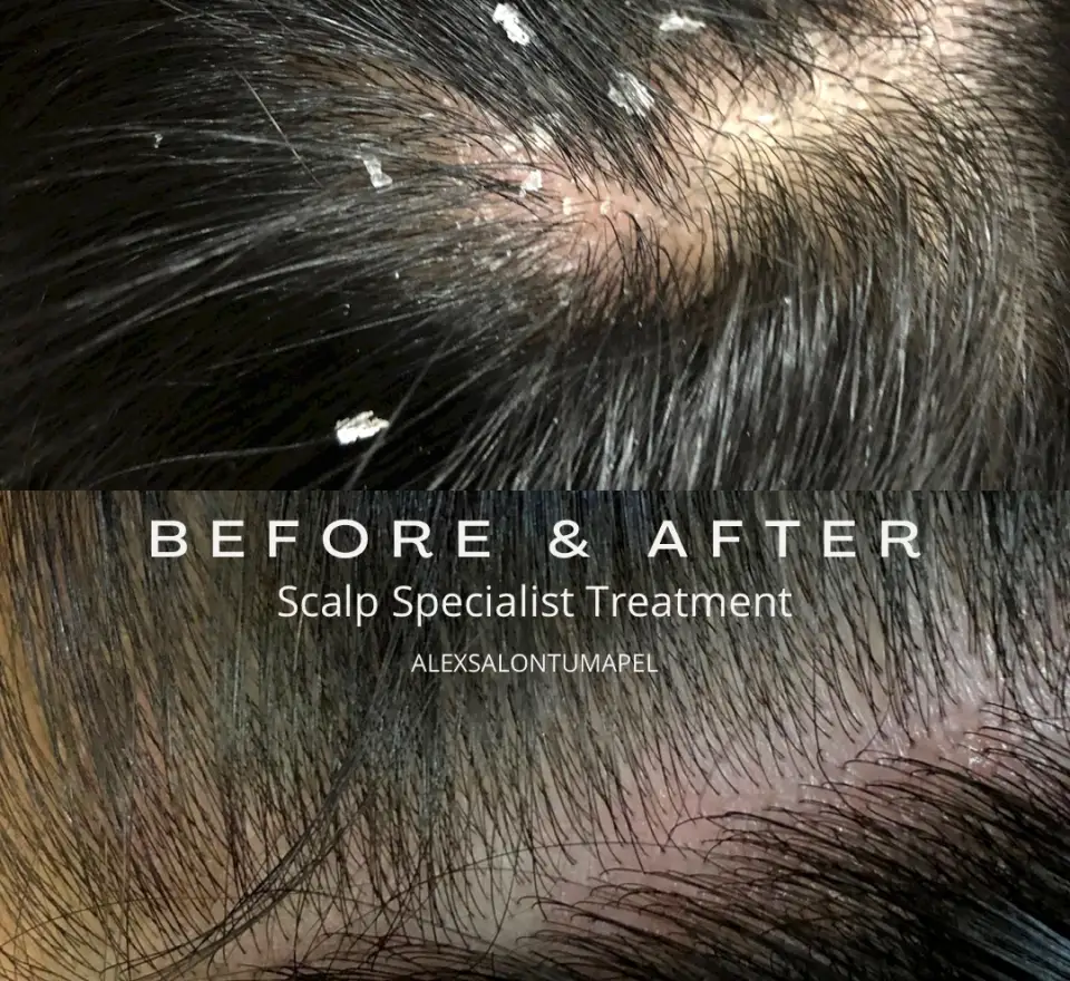 Scalp Specialist Treatment 2